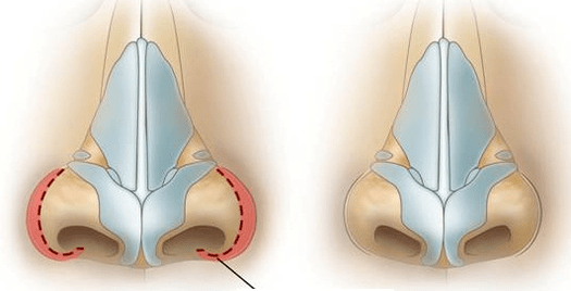 Réduction de la narine