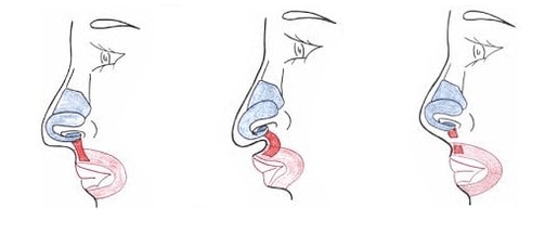 Troncature d'une partie du muscle nasal