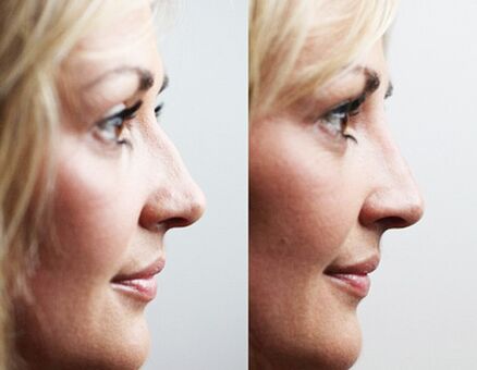 Avant et après rhinoplastie avec fillers
