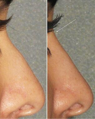 Avant et après une rhinoplastie non chirurgicale