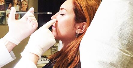 Chirurgie de rhinoplastie avec fillers