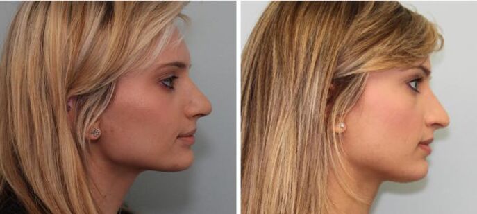 Résultats de la rhinoplastie avant et après