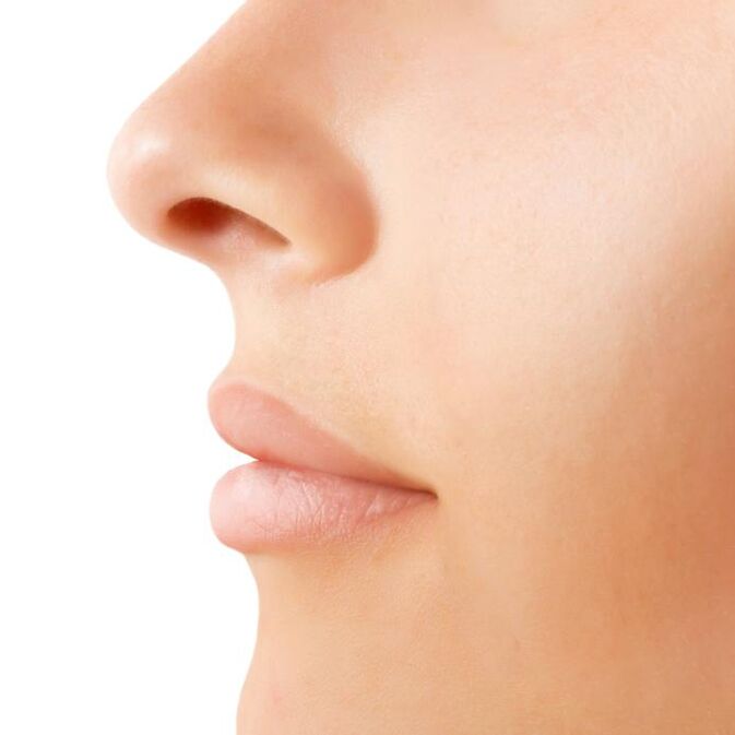 résultat d'une rhinoplastie ouverte