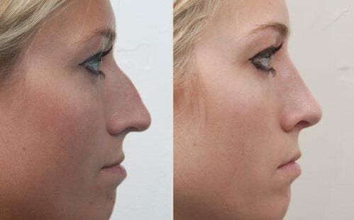 Avant et après une rhinoplastie non chirurgicale