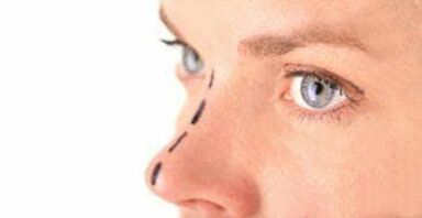 Marquage sur le nez pour l'insertion de fils cosmétiques