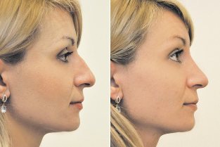 Non-chirurgicale rhinoplastie, la photo avant et après
